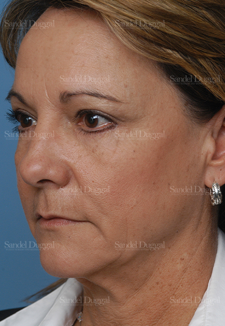 laser skin resurfacing patient