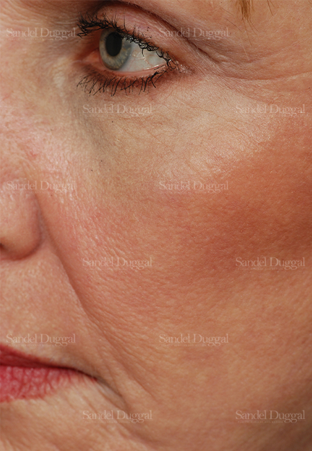 laser skin resurfacing patient