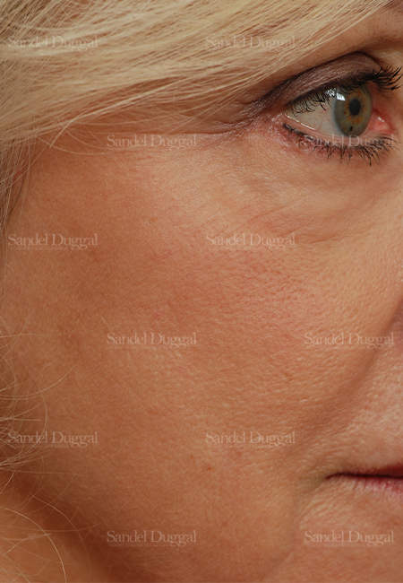 laser skin resurfacing patient