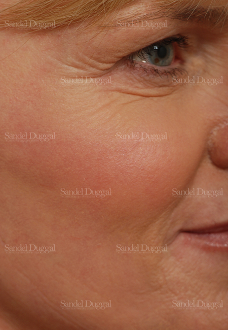 laser skin resurfacing patient