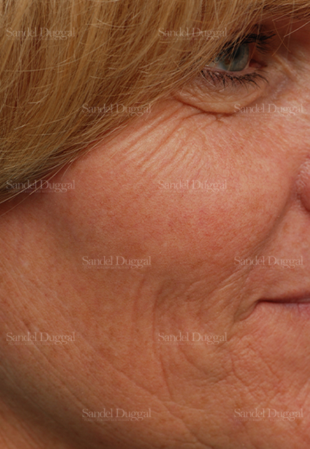 laser skin resurfacing patient