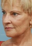 laser skin resurfacing patient