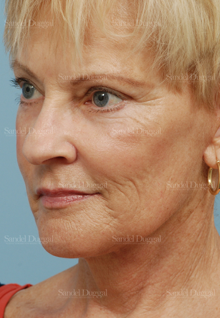 laser skin resurfacing patient