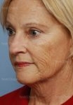 laser skin resurfacing patient