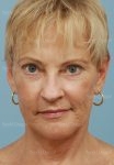 laser skin resurfacing patient