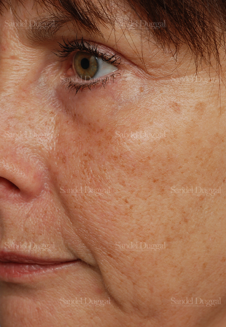 laser skin resurfacing patient