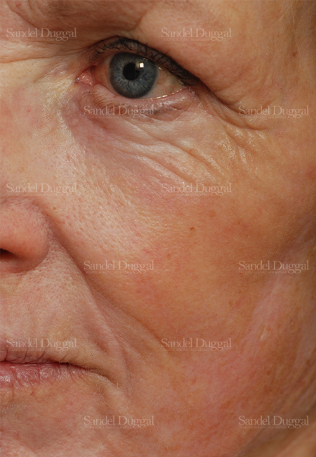 laser skin resurfacing patient