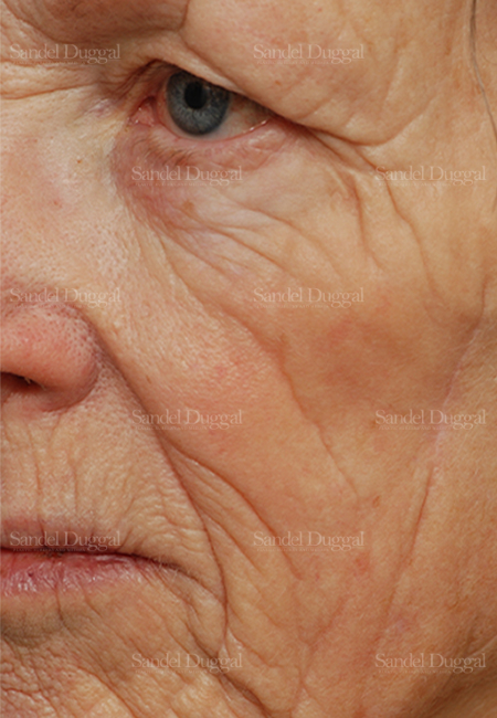 laser skin resurfacing patient