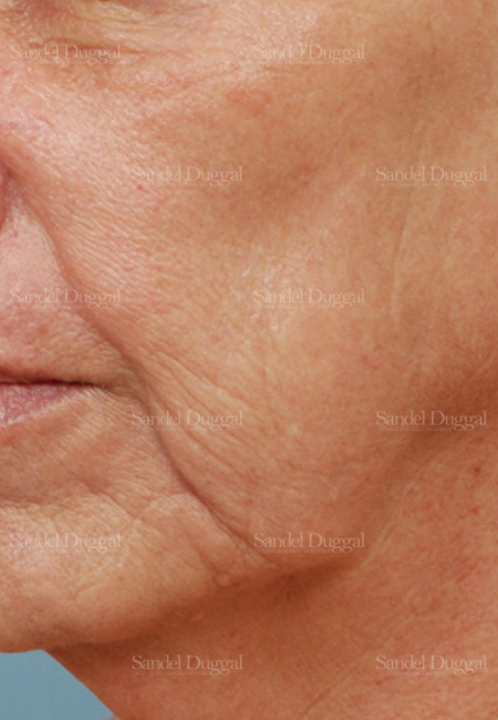 laser skin resurfacing patient