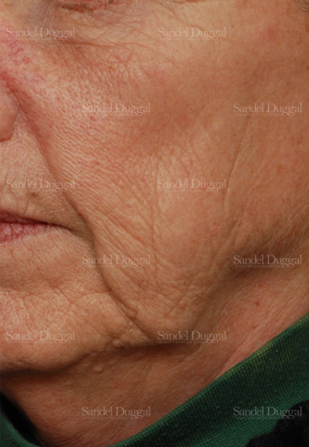 laser skin resurfacing patient