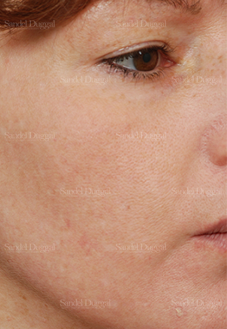 laser skin resurfacing patient