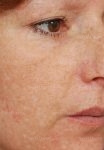 laser skin resurfacing patient