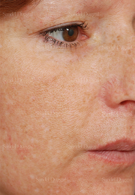 laser skin resurfacing patient