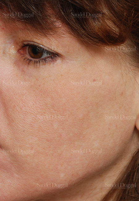 laser skin resurfacing patient