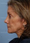 rhinoplasty patient