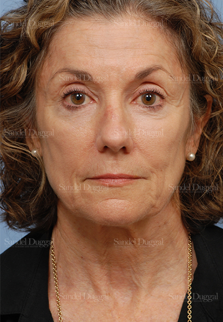 rhinoplasty patient