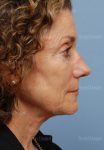 rhinoplasty patient