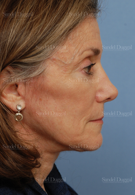 rhinoplasty patient