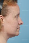 rhinoplasty patient