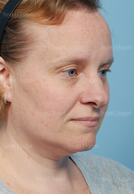 rhinoplasty patient