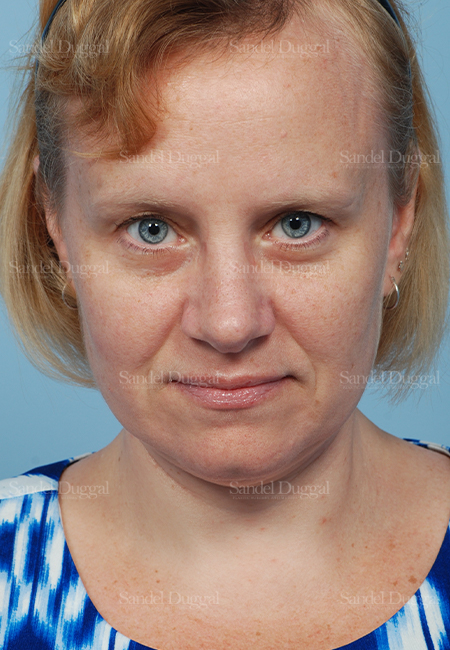 rhinoplasty patient