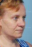 rhinoplasty patient