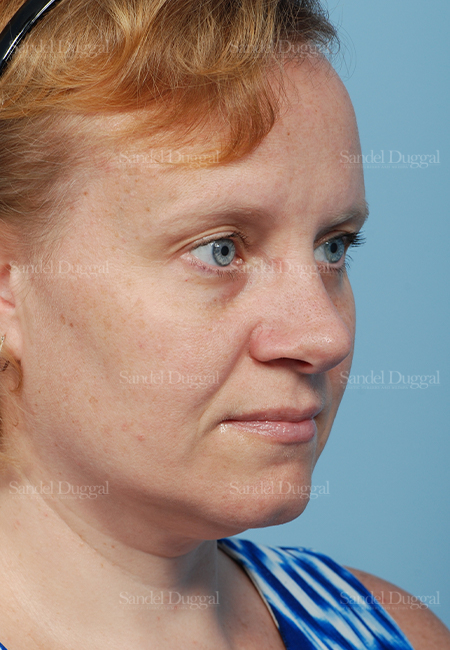 rhinoplasty patient