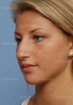 rhinoplasty patient