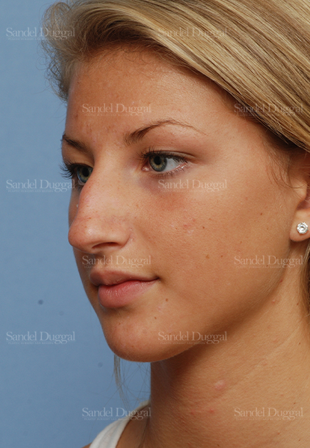 rhinoplasty patient