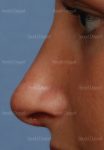 rhinoplasty patient