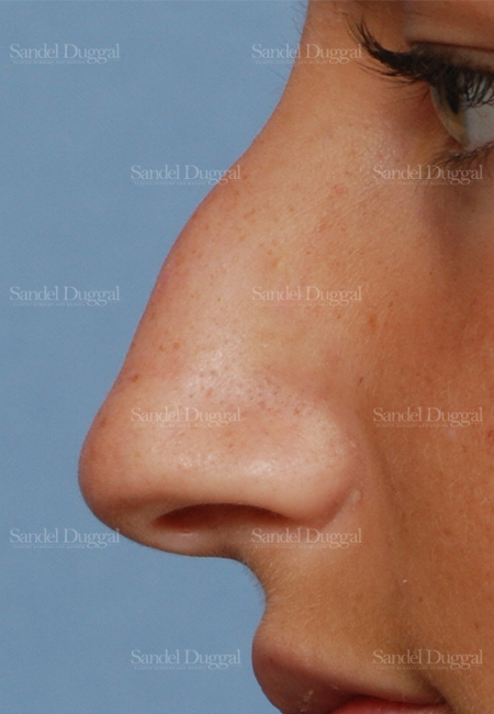 rhinoplasty patient