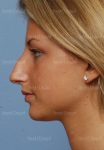 rhinoplasty patient