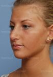 rhinoplasty patient