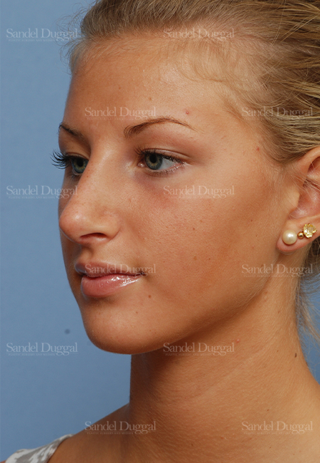 rhinoplasty patient