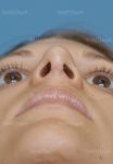 rhinoplasty patient