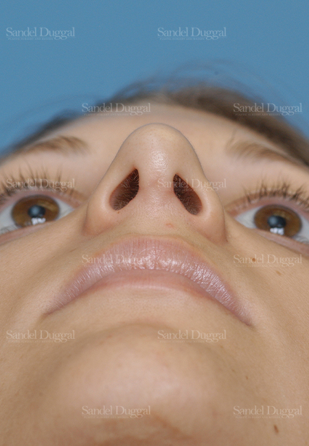 rhinoplasty patient