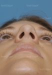 rhinoplasty patient