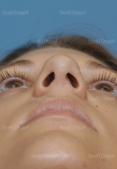 rhinoplasty patient