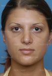 rhinoplasty patient