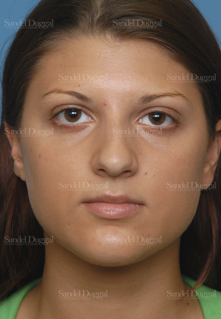 rhinoplasty patient