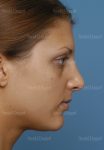 rhinoplasty patient