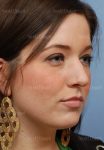 rhinoplasty patient