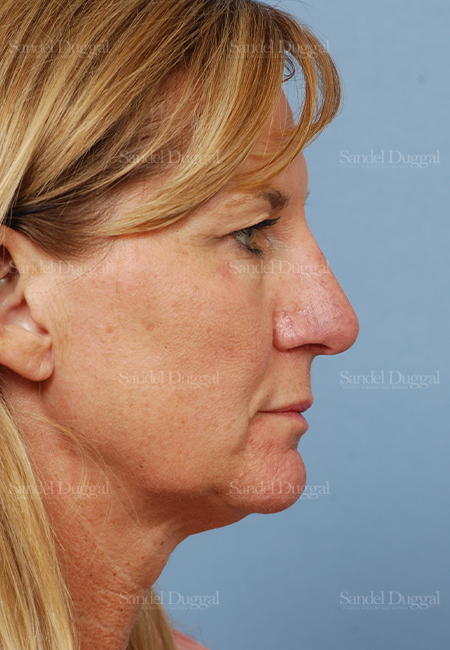 rhinoplasty patient