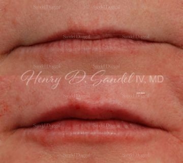 before and after lip augmentation Annapolis, MD
