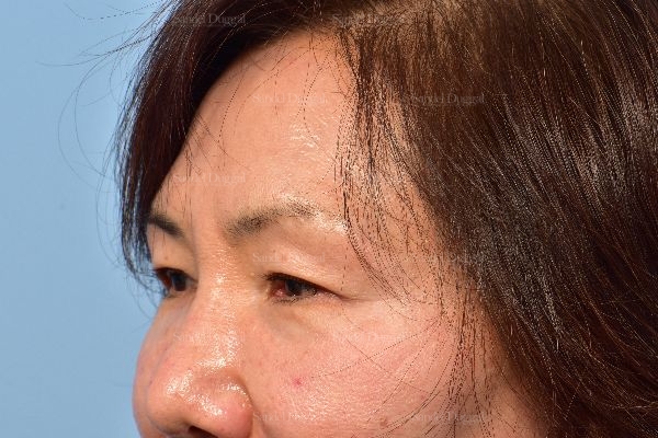 before eyelid rejuvenation angle view case 5318