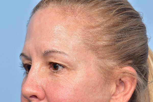 before eyelid rejuvenation angle view case 5322