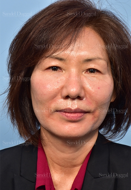 before facelift front view female patient case 5330