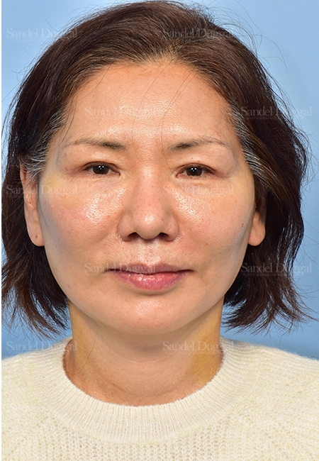 after facelift front view female patient case 5330