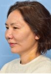 after facelift angle view female patient case 5330