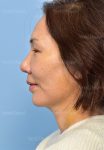 after facelift side view female patient case 5330